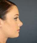 Feel Beautiful - Rhinoplasty 220 - After Photo